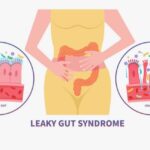 Leaky Gut Syndrome