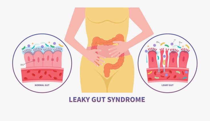 Leaky Gut Syndrome