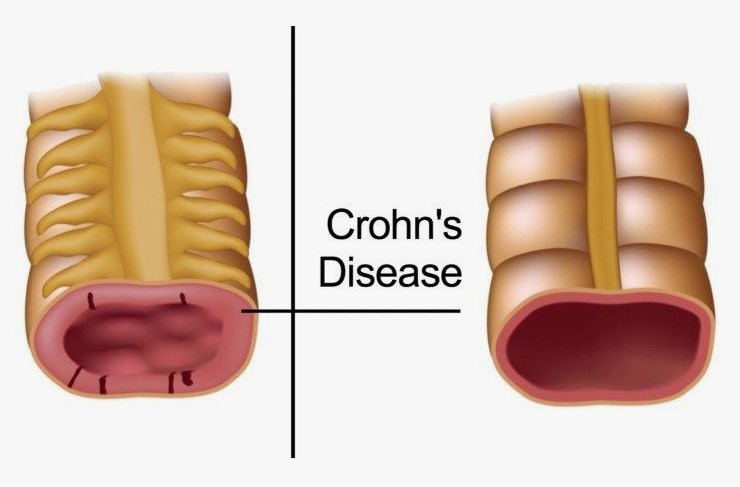Crohn’s Disease