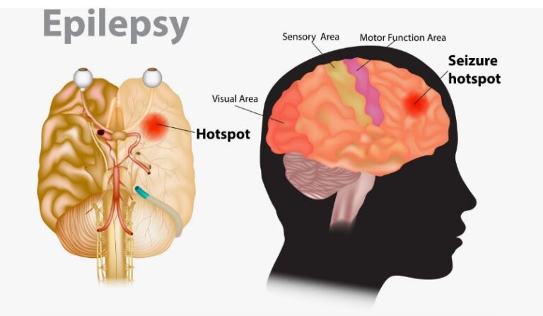 Epilepsy