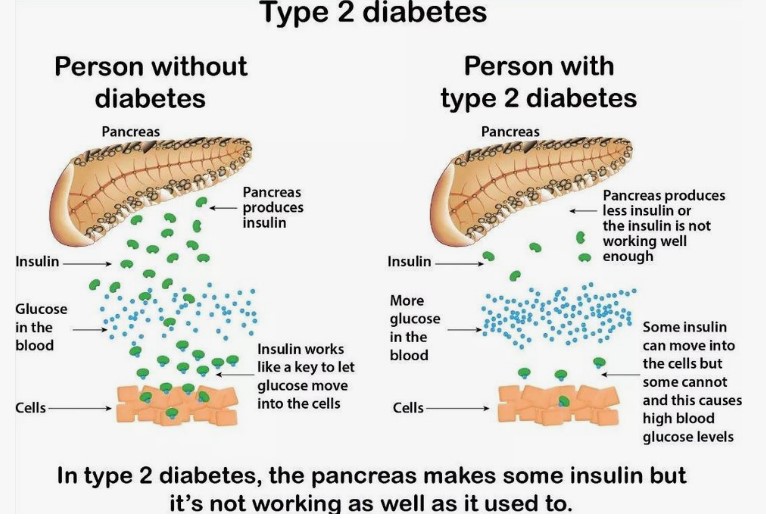 Diabetes (Type 2)