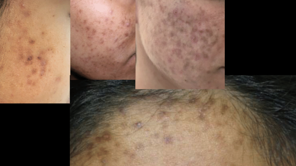 Acne Vulgaris | Causes, Symptoms, and Effective Treatment Solutions HYPERPIGMENTATION POST ACNE