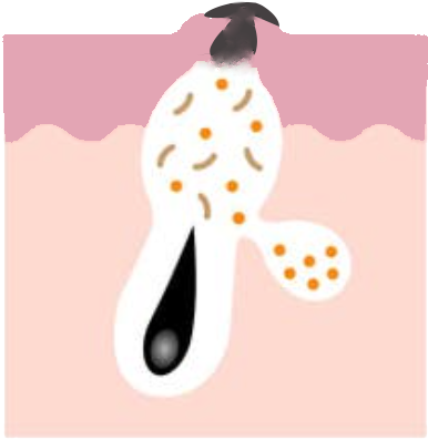 Acne Vulgaris | Causes, Symptoms, and Effective Treatment Solutions Blackehead