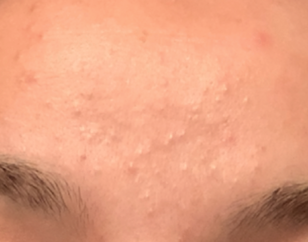Acne Vulgaris | Causes, Symptoms, and Effective Treatment Solutions COMEDONES