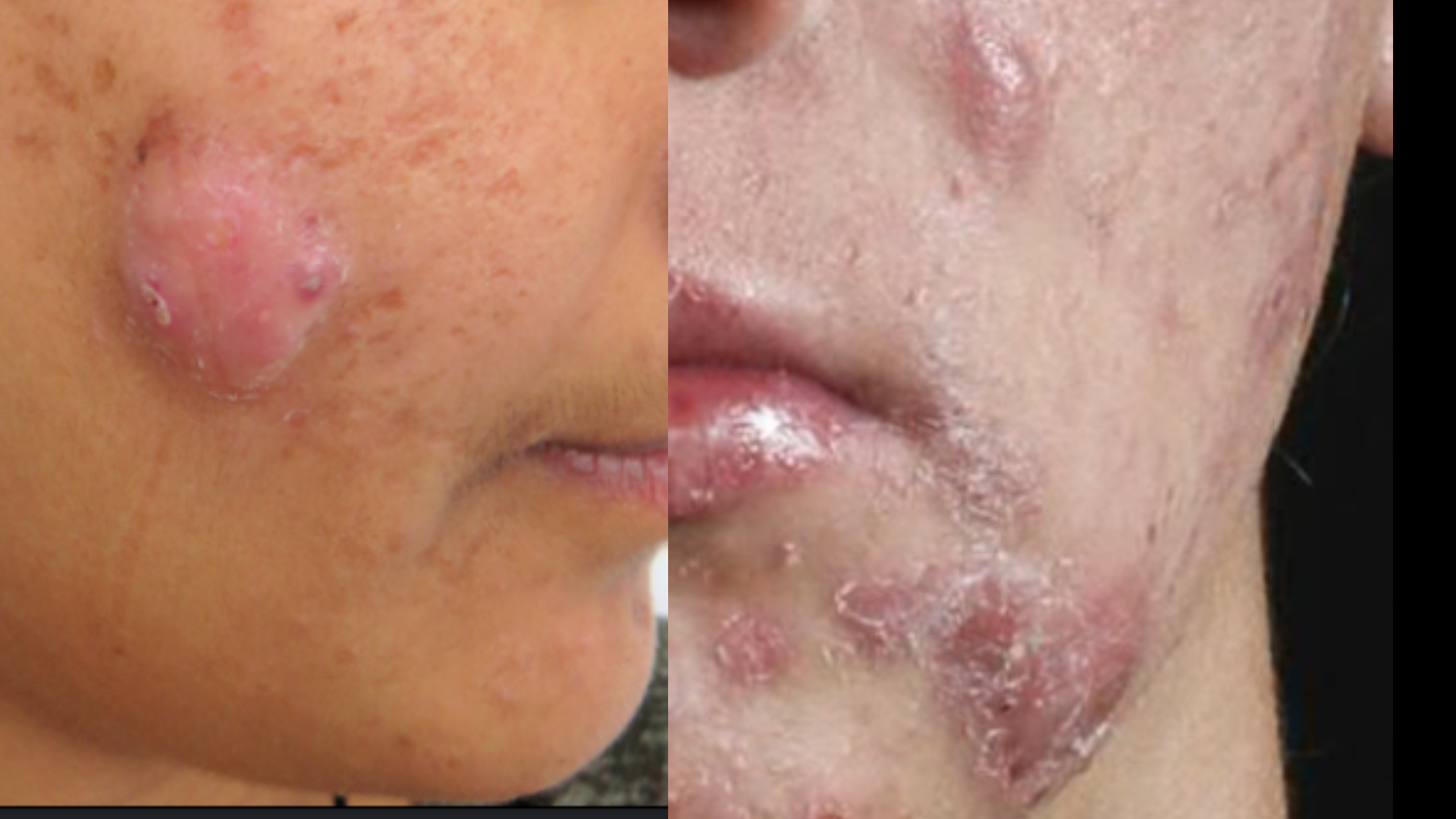 Acne Vulgaris | Causes, Symptoms, and Effective Treatment Solutions CYSTIC ACNE