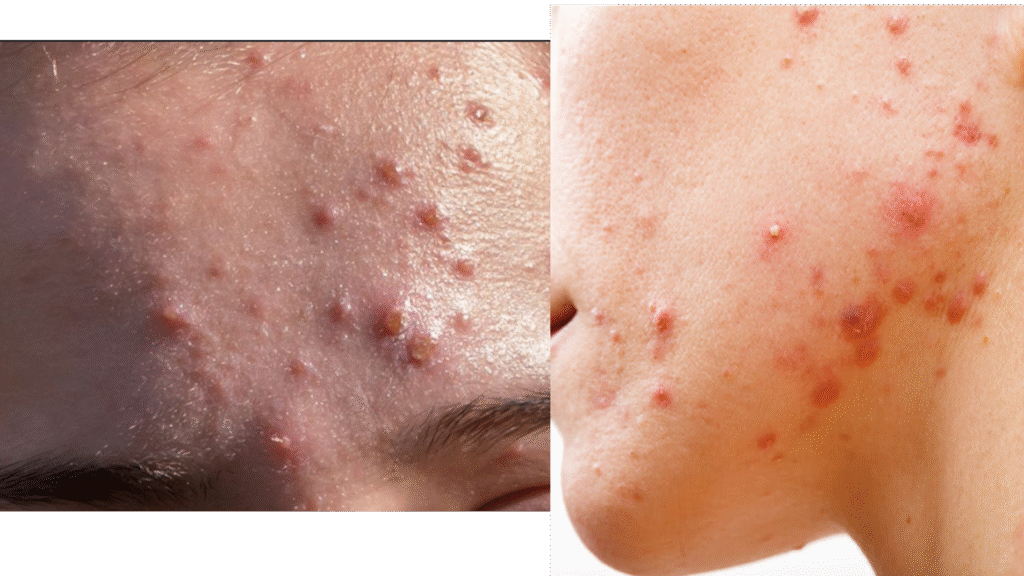 Acne Vulgaris | Causes, Symptoms, and Effective Treatment Solutions NODULAR ACNE