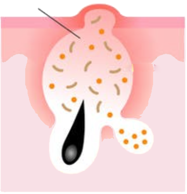 Acne Vulgaris | Causes, Symptoms, and Effective Treatment Solutions Papules
