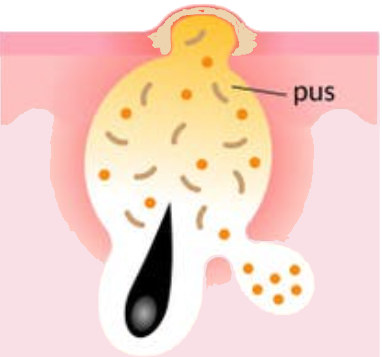 Acne Vulgaris | Causes, Symptoms, and Effective Treatment Solutions Pustules