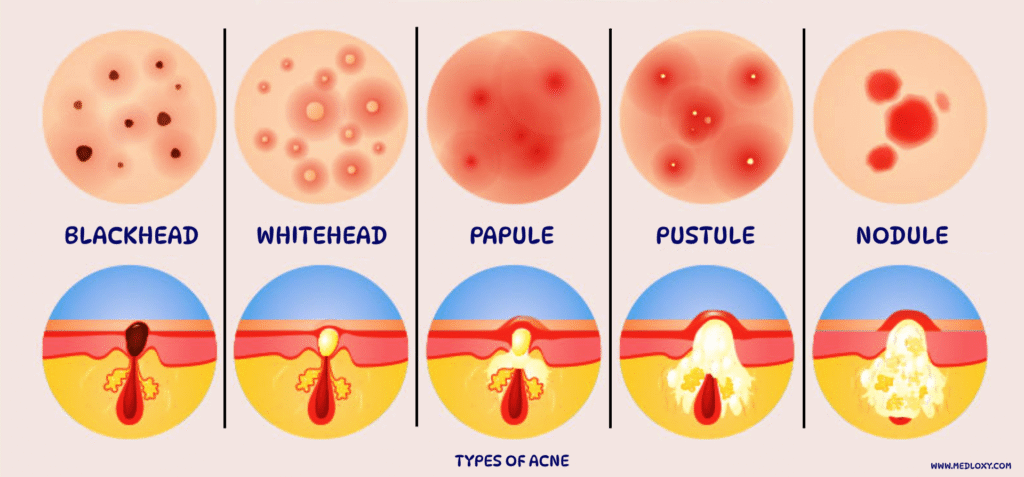 Acne Vulgaris | Causes, Symptoms, and Effective Treatment Solutions