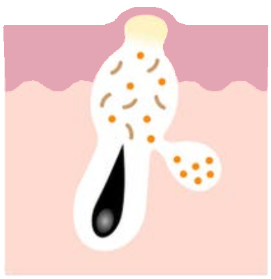 Acne Vulgaris | Causes, Symptoms, and Effective Treatment Solutions whitehead